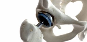 Illustration of a hip replacement.